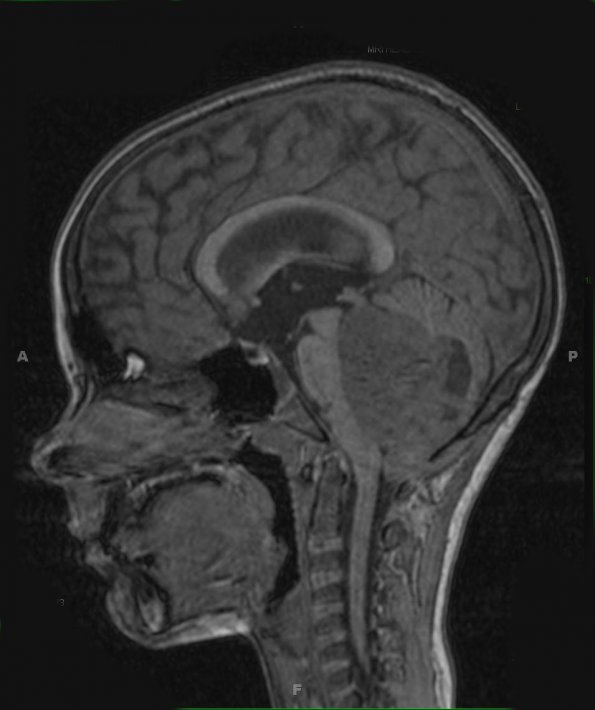 2A1 Medulloblastoma LCA (Case 2) MRI 1 - Copy