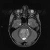 2A2 Medulloblastoma LCA (Case 2) MRI 3 - Copy