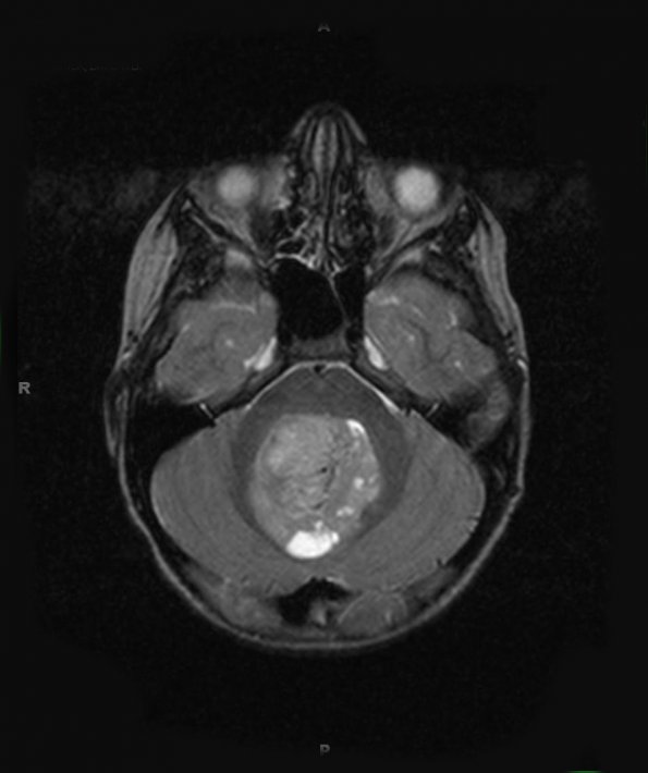 2A2 Medulloblastoma LCA (Case 2) MRI 3 - Copy