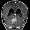 2A3 Medulloblastoma LCA (Case 2) MRI 5 - Copy