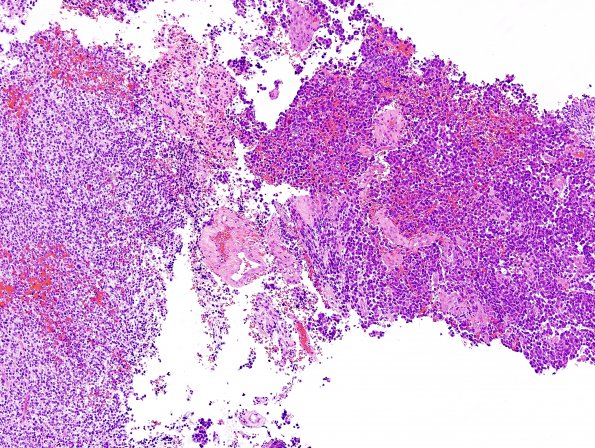 2B1 MB LCA (Case 2) H&E 2