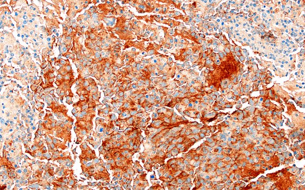 3H1 MB LCA (Case 3) B-Catenin 1