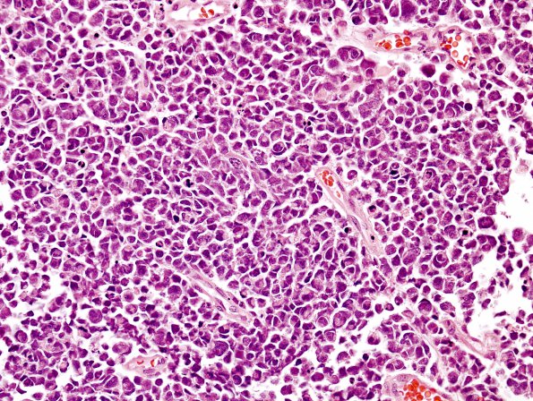 4A1 Medulloblastoma, LCA (Case 4) H&E 7