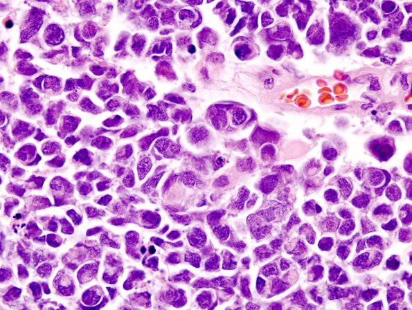 4A2 Medulloblastoma, LCA (Case 4) H&E 5