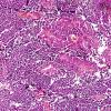 4A3 Medulloblastoma, LCA (Case 4) H&E 10