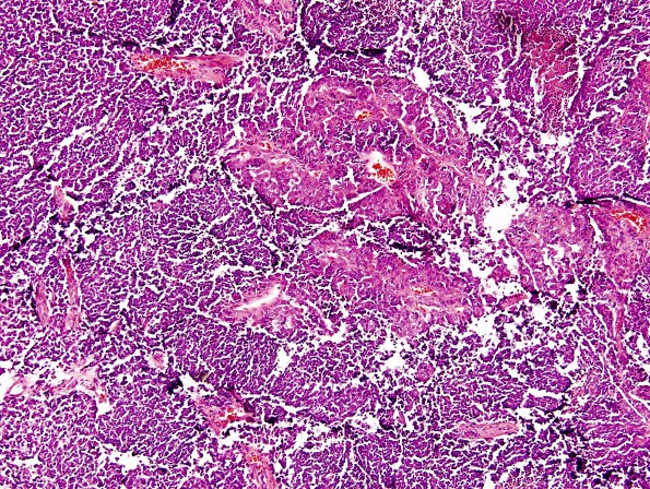 4A3 Medulloblastoma, LCA (Case 4) H&E 10