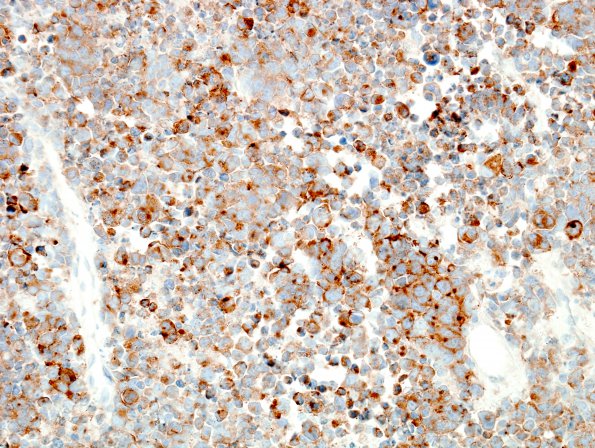 4B Medulloblastoma, LCA (Case 4) SYN