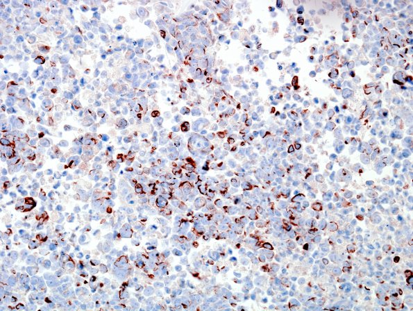 4C Medulloblastoma, LCA (Case 4) NFil