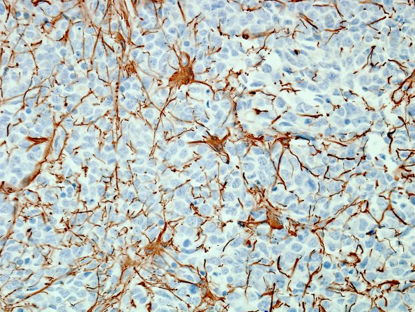 4D Medulloblastoma, LCA (Case 4) GFAP