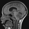 5A Medulloblastoma, LCA (Case 5) T1 1 - Copy