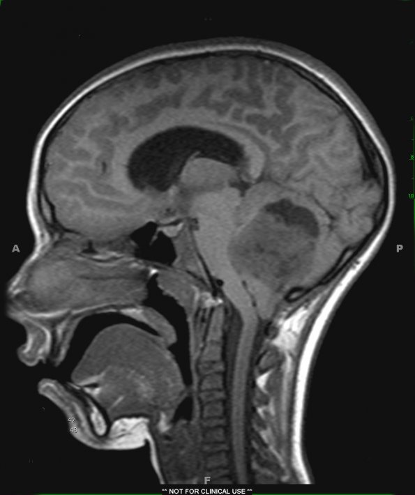 5A Medulloblastoma, LCA (Case 5) T1 1 - Copy