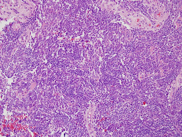 5B1 Medulloblastoma, LCA (Case 5) H&E 7