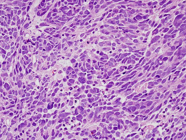 5B2 Medulloblastoma, LCA (Case 5) H&E 10