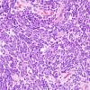 5B3 Medulloblastoma, LCA (Case 5) H&E 12