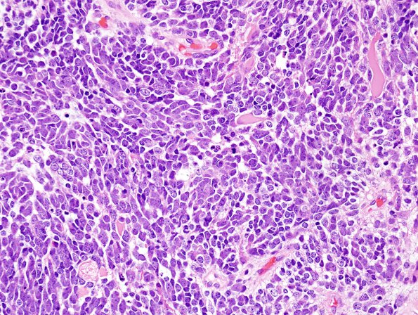 5B3 Medulloblastoma, LCA (Case 5) H&E 12