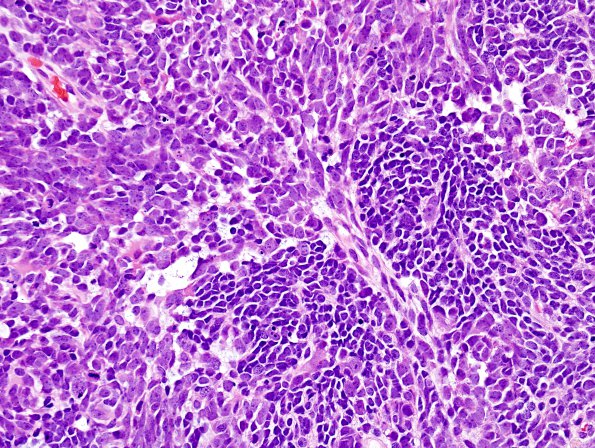 5B4 Medulloblastoma, LCA (Case 5) H&E 14