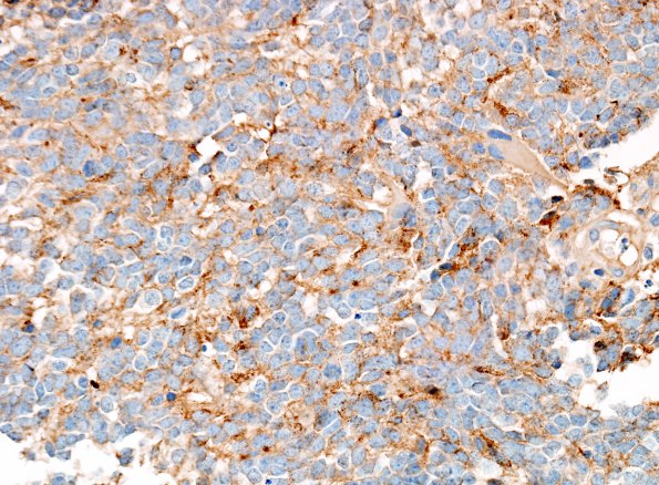 5C1 Medulloblastoma, LCA (Case 5) Chrom 1