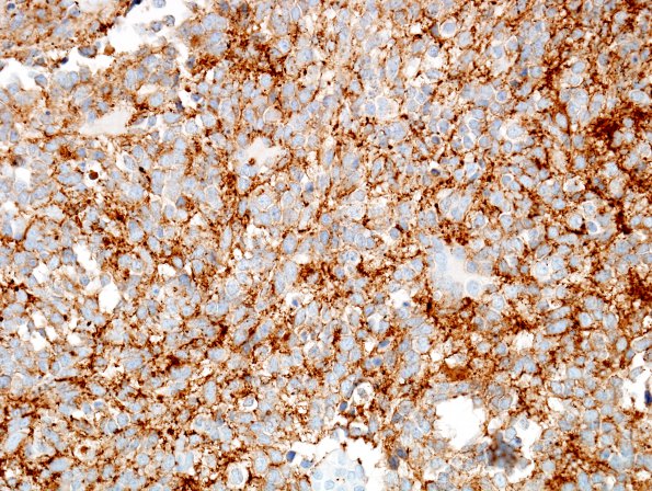 5C2 Medulloblastoma, LCA (Case 5) SYN 1