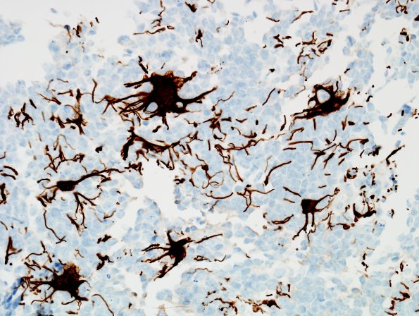 5D Medulloblastoma, LCA (Case 5) GFAP 1