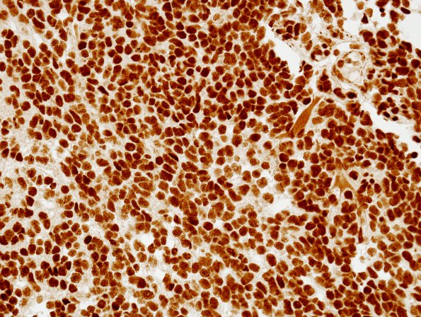 5F Medulloblastoma, LCA (Case 5) BAF47