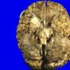 6A1 Medulloblastoma (Case 6) 3