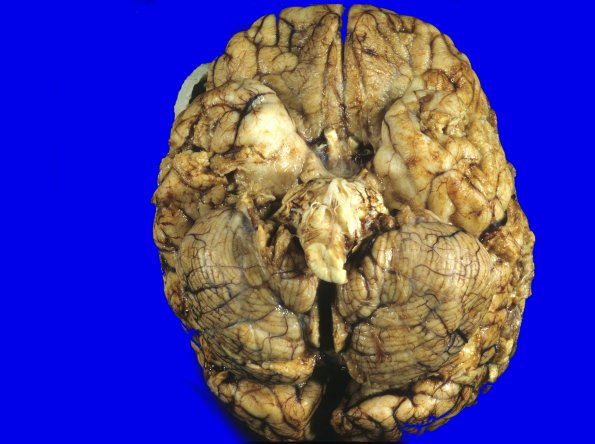 6A1 Medulloblastoma (Case 6) 3