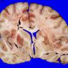 6A2 Medulloblastoma & Moyamoya & ECAD (Case 6) A4