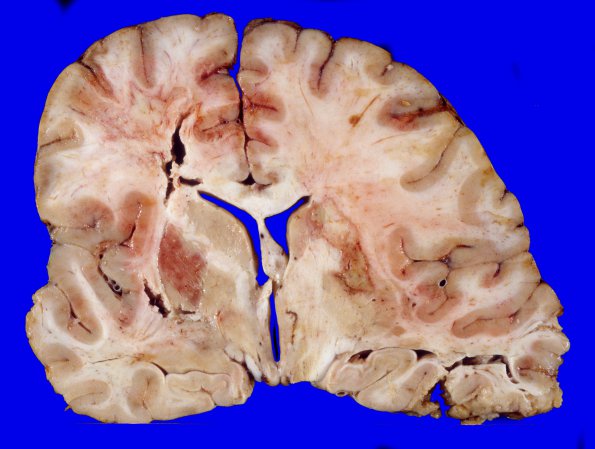 6A2 Medulloblastoma & Moyamoya & ECAD (Case 6) A4