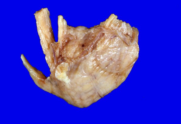 6A3 Medulloblastoma (Case 6) 1