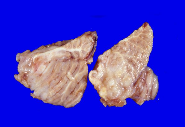 6A4 Medulloblastoma (Case 6) 2