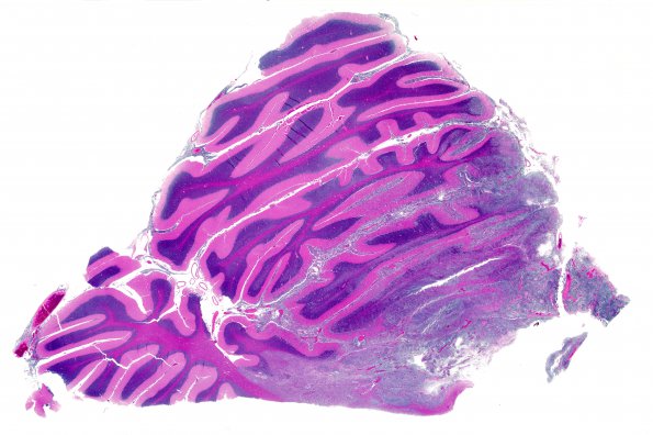 6B2 Medulloblastoma & Moyamoya & ECAD (Case 6) H&E WM