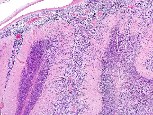 6B3 Medulloblastoma, rentry (Case 6) H&E 1