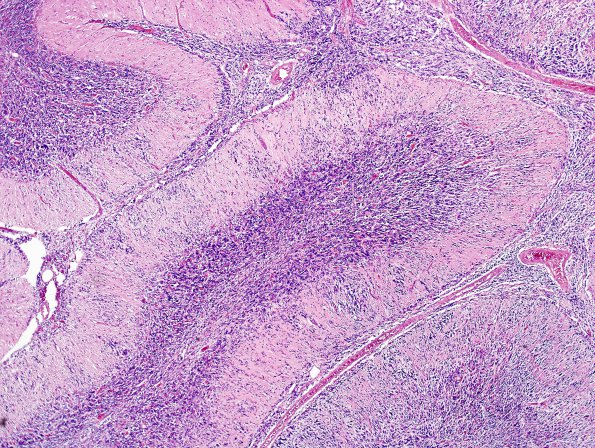 6B4 Medulloblastoma, rentry (Case 6) H&E 3