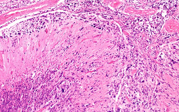 6B5 Medulloblastoma (Case 6) N10 10X