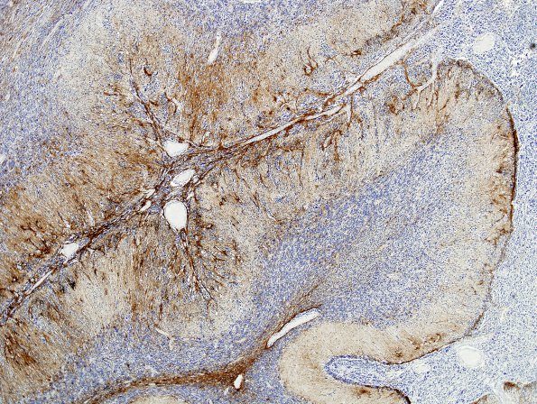 6D1 Medulloblastoma, re entry (Case 6) GFAP 4