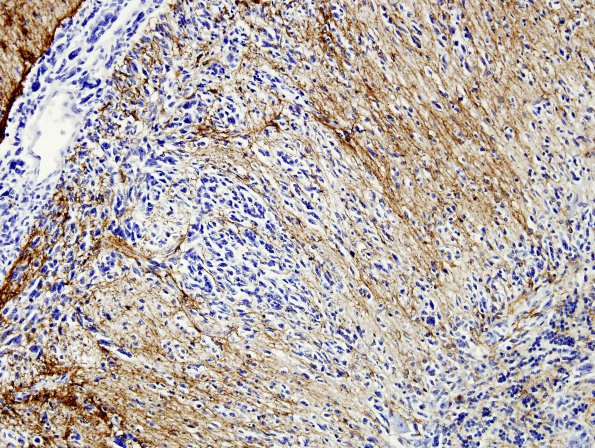 6D2 Medulloblastoma, re-entry (Case 6) GFAP 1