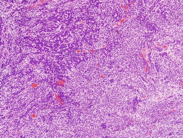 7A1 Medulloblastoma (Case 7) H&E 3