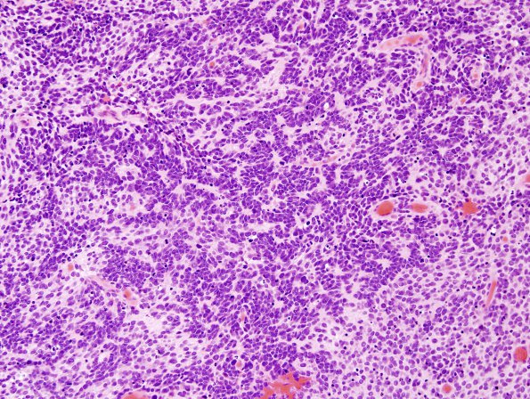 7A2 Medulloblastoma (Case 7) H&E 2