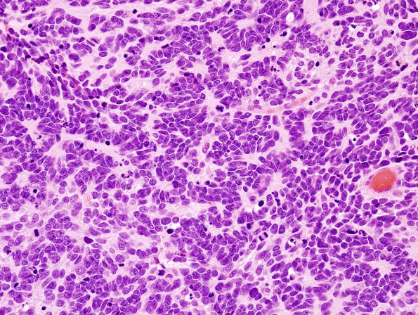 7A3 Medulloblastoma (Case 7) H&E 1