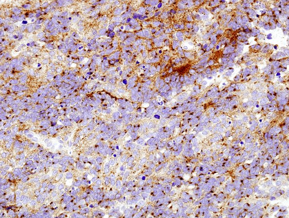 7B Medulloblastoma (Case 7) SYN 3