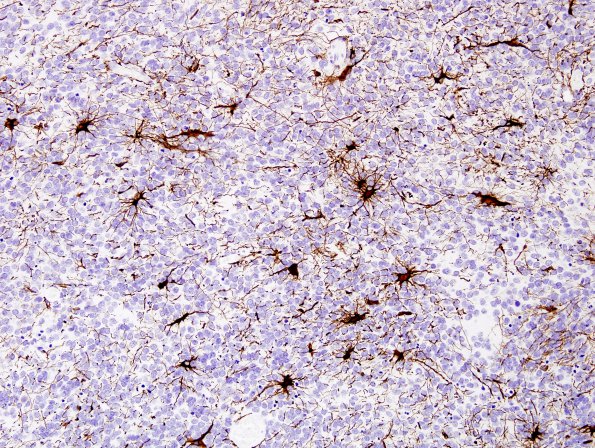 7C Medulloblastoma (Case 7) GFAP 3