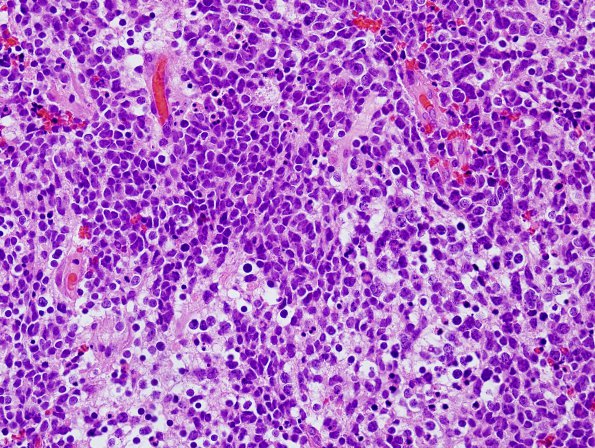  8A1 Medulloblastoma, LCA (Case 8) H&E 7 - Copy.jpg