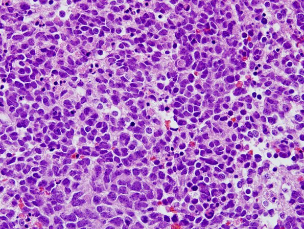 8A2 Medulloblastoma, LCA (Case 8) H&E 8 - Copy.jpg