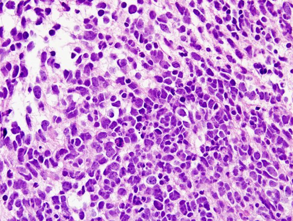 8A3 Medulloblastoma, LCA (Case 8) H&E 1.jpg