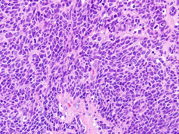 8A4 Medulloblastoma, LCA (Case 8) H&E 4 - Copy.jpg