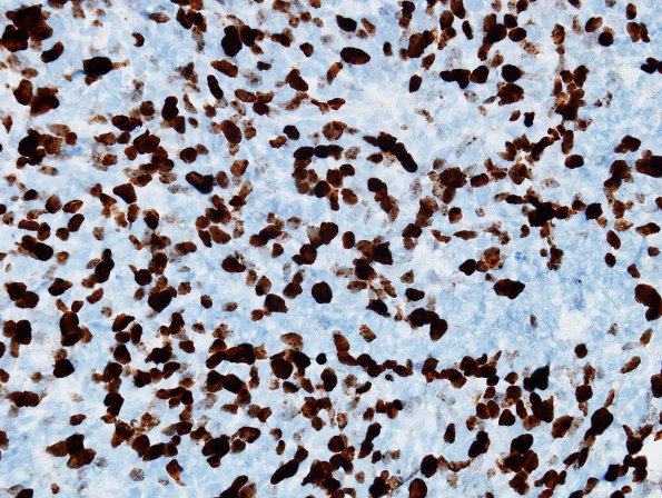 8C Medulloblastoma, LCA (Case 8) Ki67.jpg