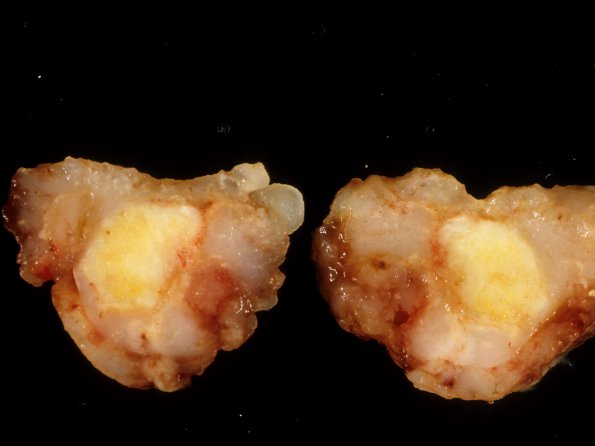 9A Medulloblastoma, LCA (Case 9) gross 1