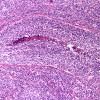 9B1 Medulloblastoma, LCA (Case 9) 1