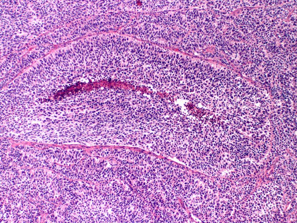 9B1 Medulloblastoma, LCA (Case 9) 1