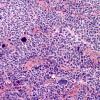 9B2 Medulloblastoma, LCA (Case 9) H&E 4